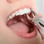 ZAHNEXTRAKTION