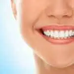 E-MAX VENEERS