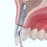 MEDENTIKA IMPLANTAT