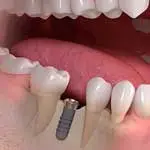 STRAUMANN IMPLANTAT